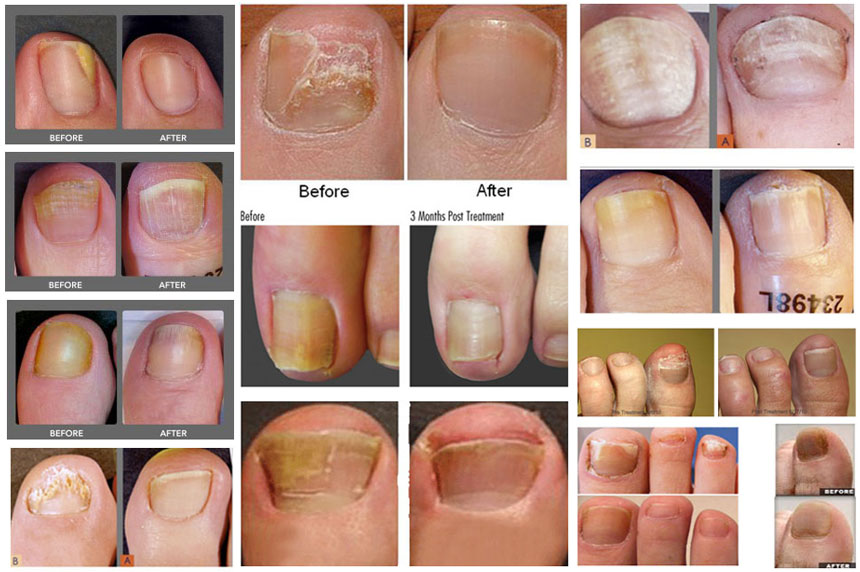 how-i-got-rid-of-toenail-fungus-quickly-naturally-feathers-in-the